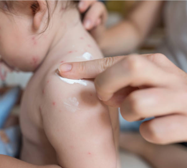 Why is the use of baby rash cream important for kids and babies?