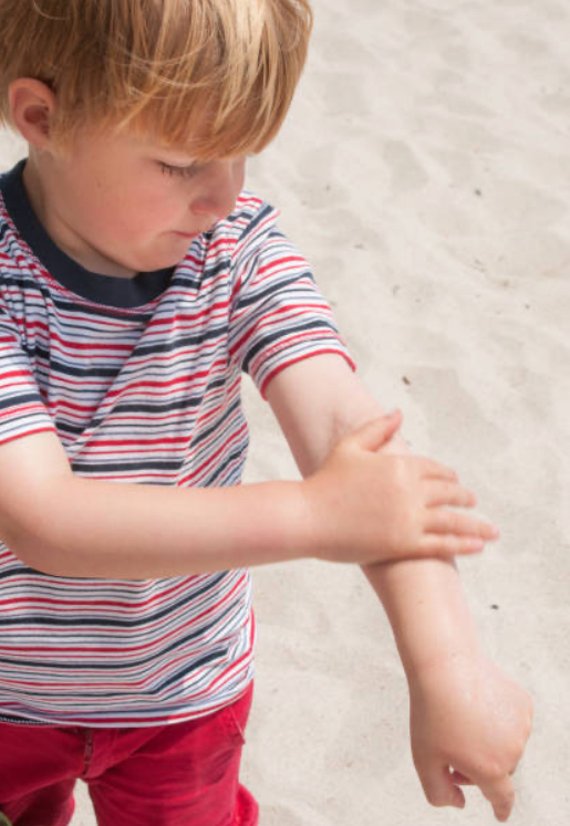 A child with aloe vera gel applied to soothe sunburned skin.